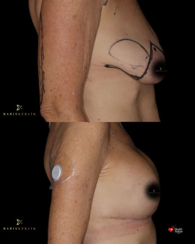 Breast before and after with Dr. Barış Keklik – Before and after