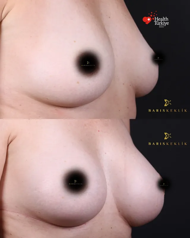 Breast before and after with Dr. Barış Keklik – Before and after