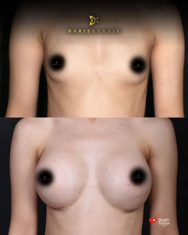 Breast before and after with Dr. Barış Keklik – Before and after