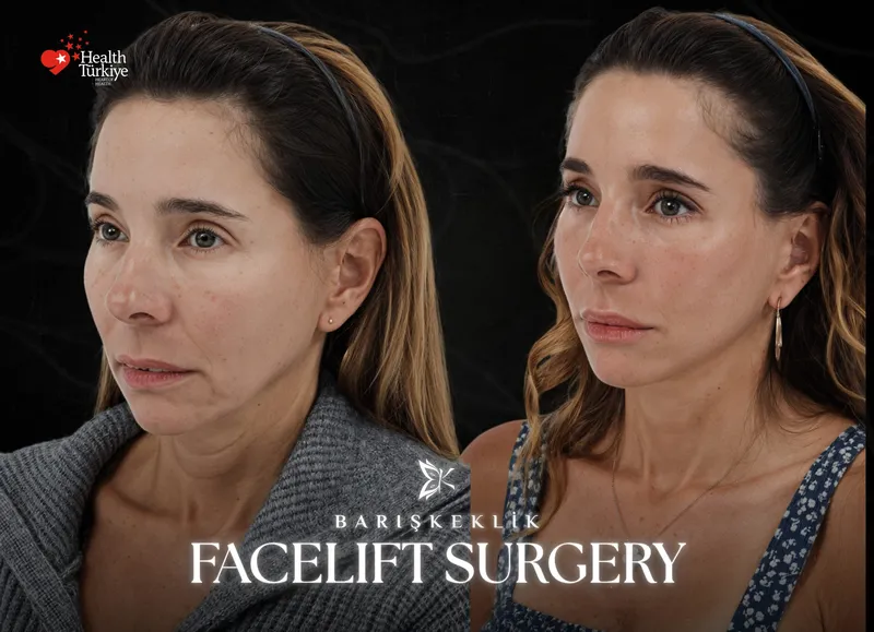 Facelift before and after with Dr. Barış Keklik – Before and after