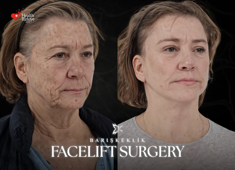 Facelift before and after with Dr. Barış Keklik – Before and after