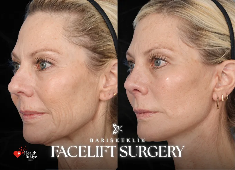 Facelift before and after with Dr. Barış Keklik – Before and after