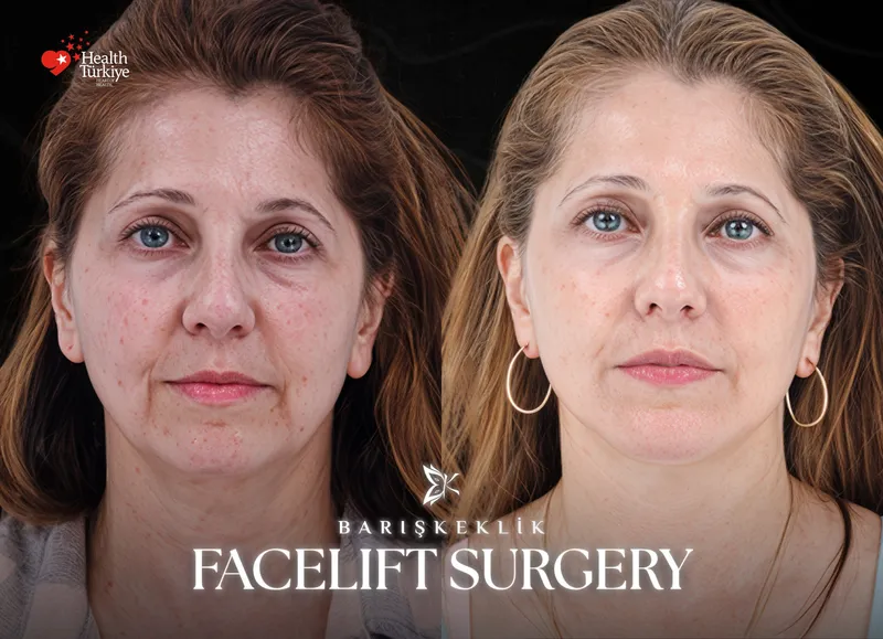 Facelift before and after with Dr. Barış Keklik – Before and after