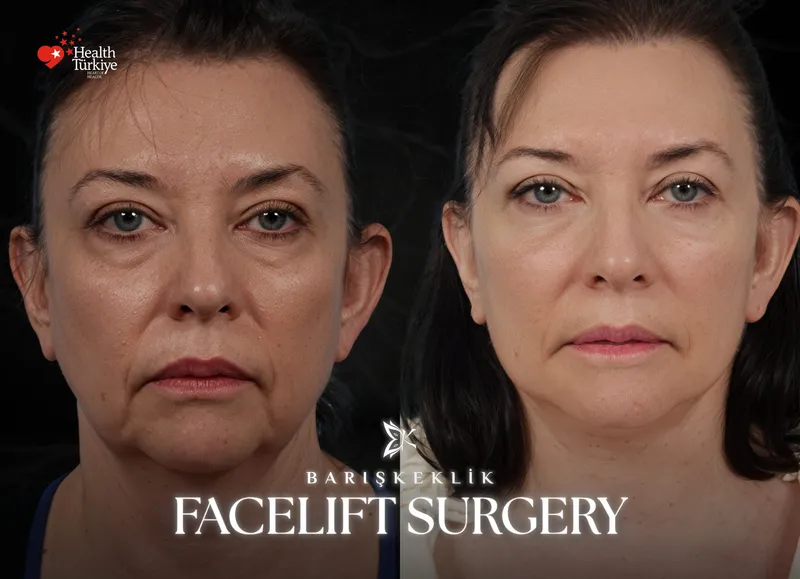 Facelift before and after with Dr. Barış Keklik – Before and after