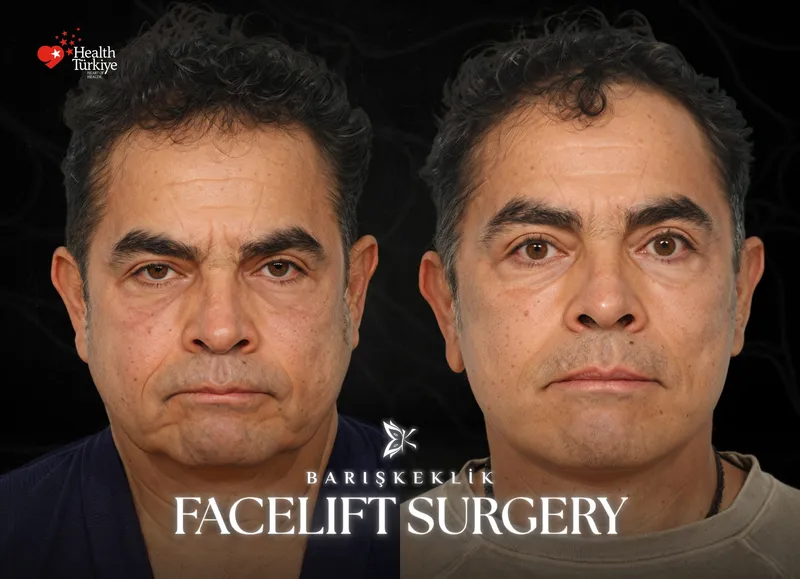 Facelift before and after with Dr. Barış Keklik – Before and after