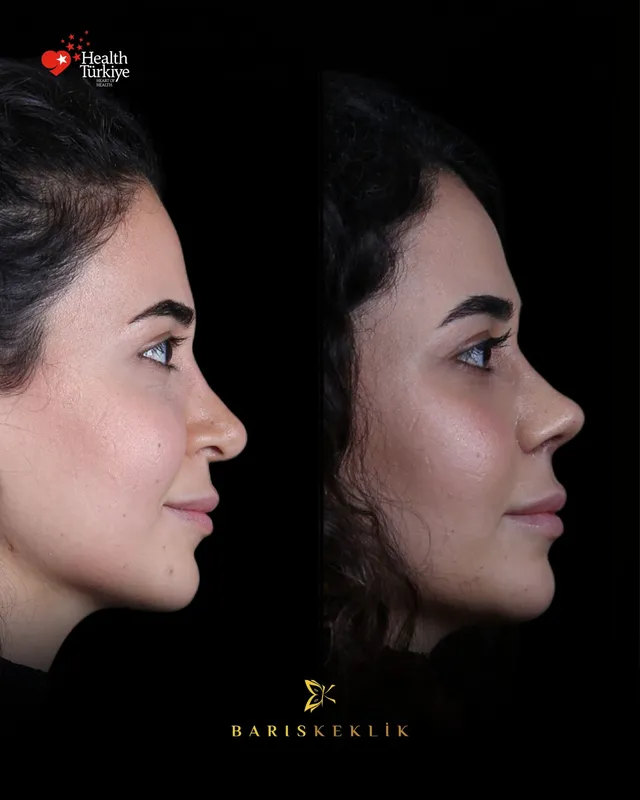 Rhinoplasty before and after with Dr. Barış Keklik – Before and after
