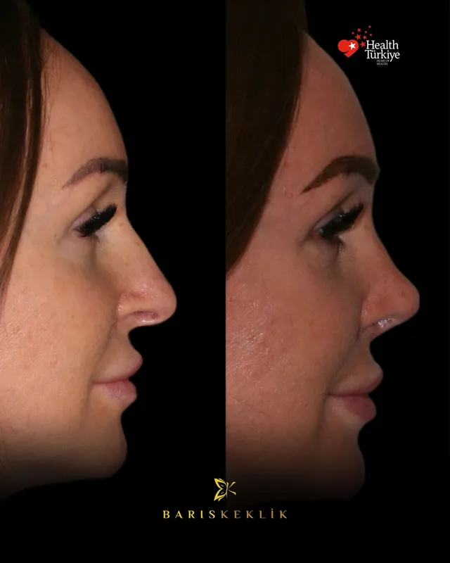 Rhinoplasty before and after with Dr. Barış Keklik – Before and after