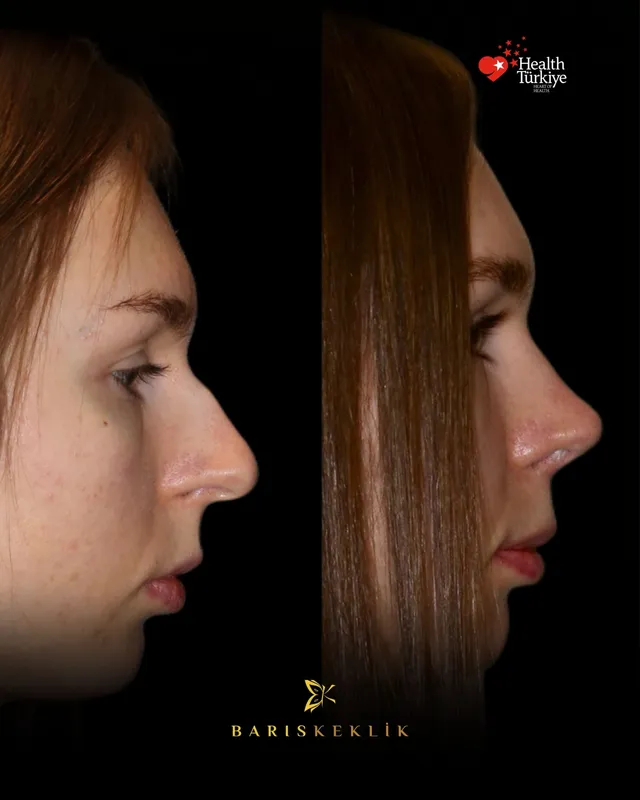 Rhinoplasty before and after with Dr. Barış Keklik – Before and after