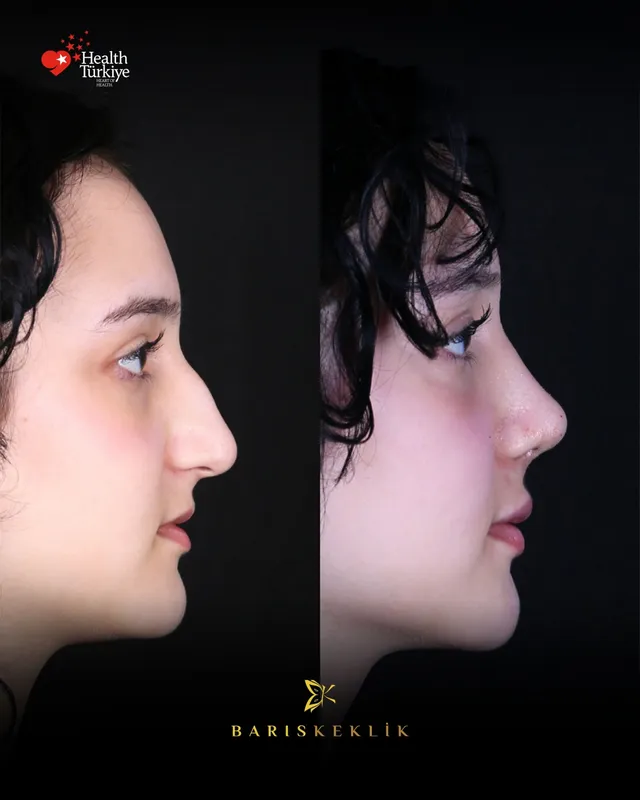 Rhinoplasty before and after with Dr. Barış Keklik – Before and after