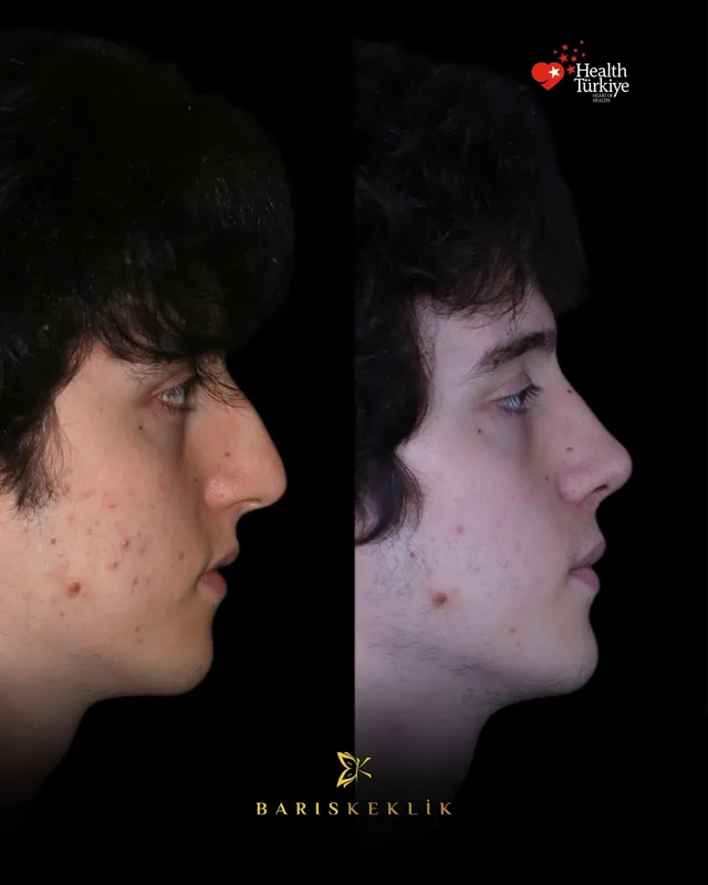 Rhinoplasty before and after with Dr. Barış Keklik – Before and after