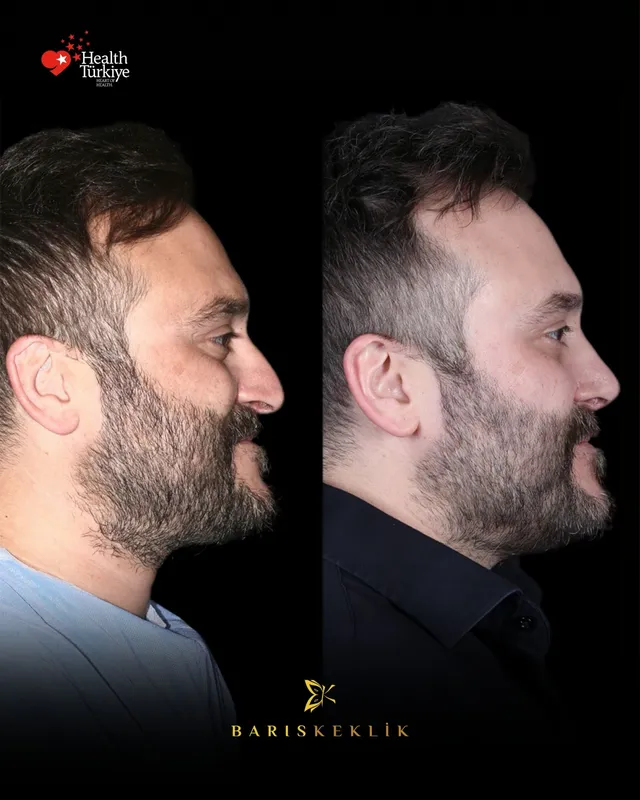 Rhinoplasty before and after with Dr. Barış Keklik – Before and after